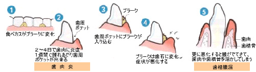 歯周病の原因のイラスト