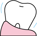 歯周病(歯槽膿漏)の治療のイラスト